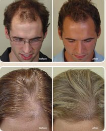 Трансплантация (пересадка) волос