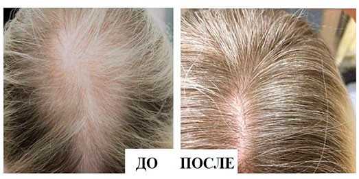 Регулярный массаж кожи головы
